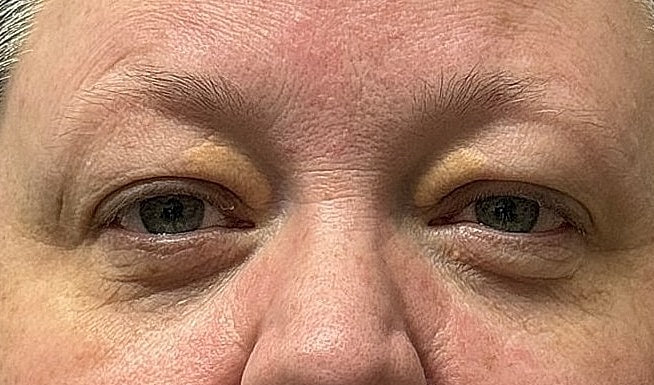 Close-up of woman’s eyes and forehead skin.